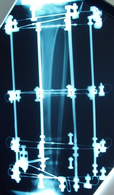 Tibia, Shaft:  Smith & Nephew Ilizarov (Implant 190)